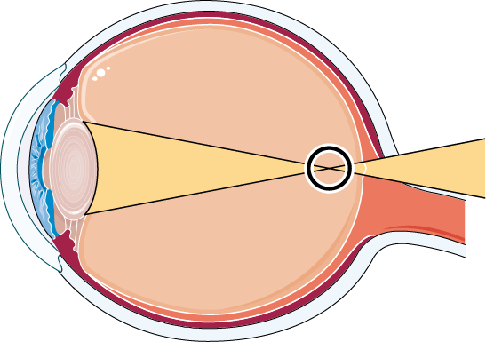 Anatomie eines kurzsichtigen Auges
